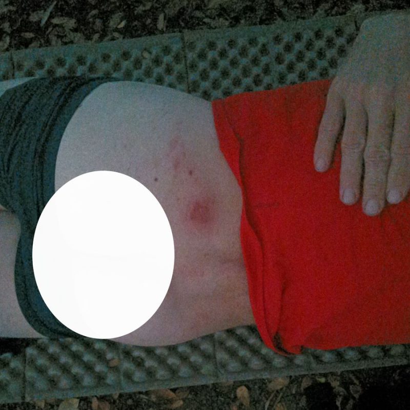 Plaie au dos par un frottement de mon sac.