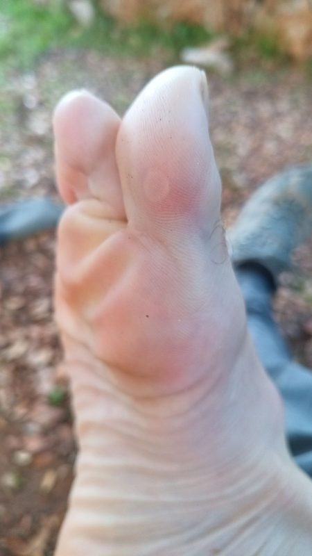 Début d'ampoule au pied.