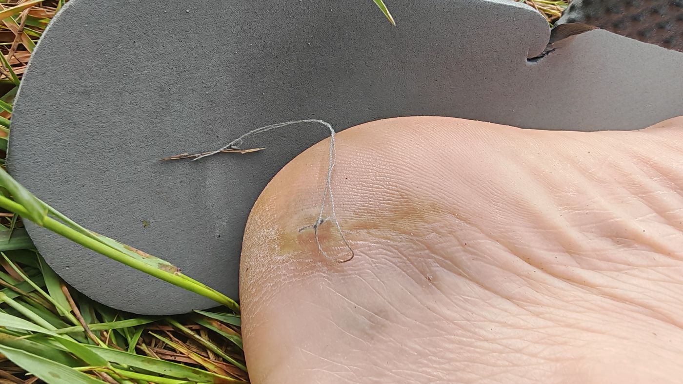 Fil passé pour sécher un début d'ampoule